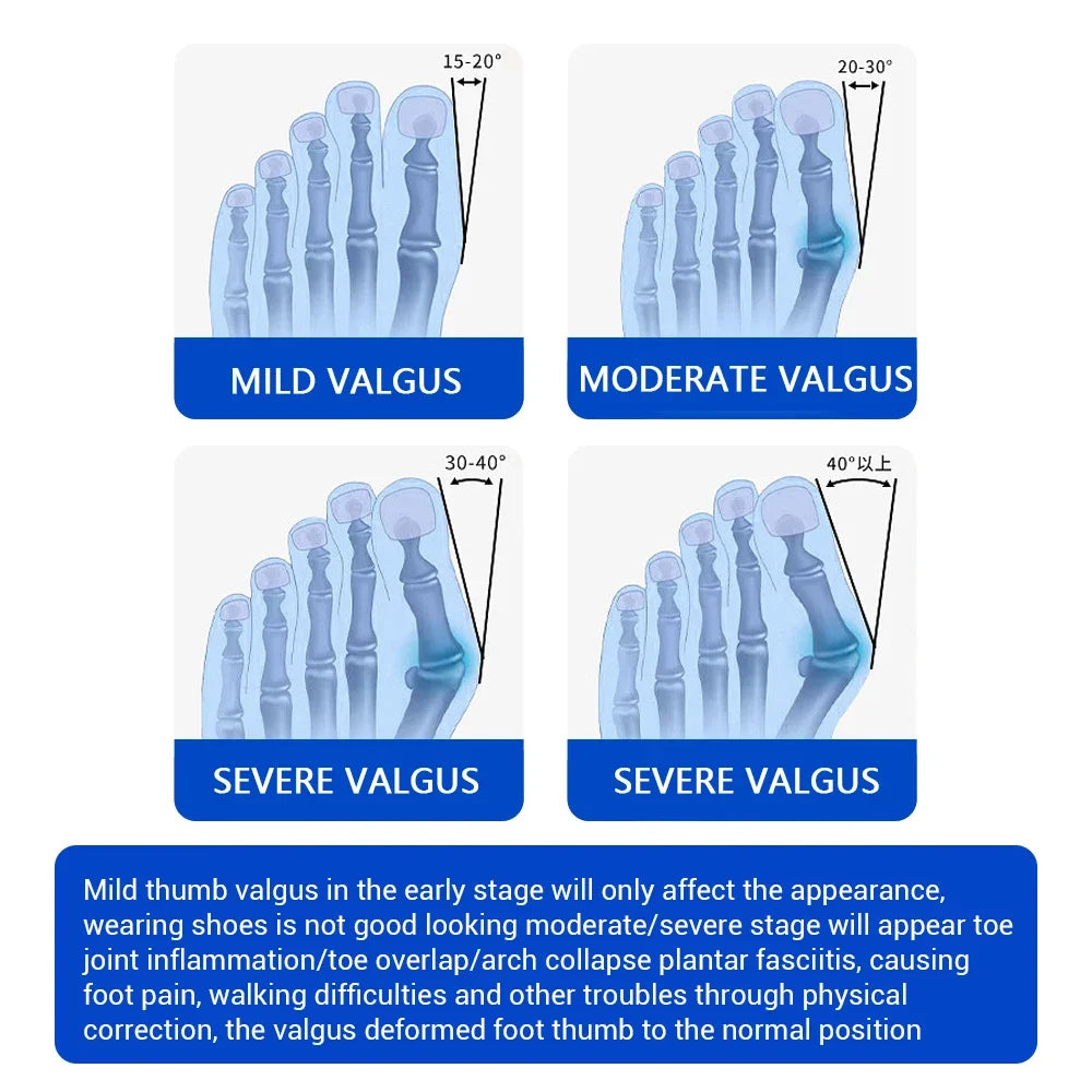 Bunion Splint Big Toe Straightener Hallux Valgus Correction Orthotics Foot Bone Thumb Adjuster Correction Bunions Corrector