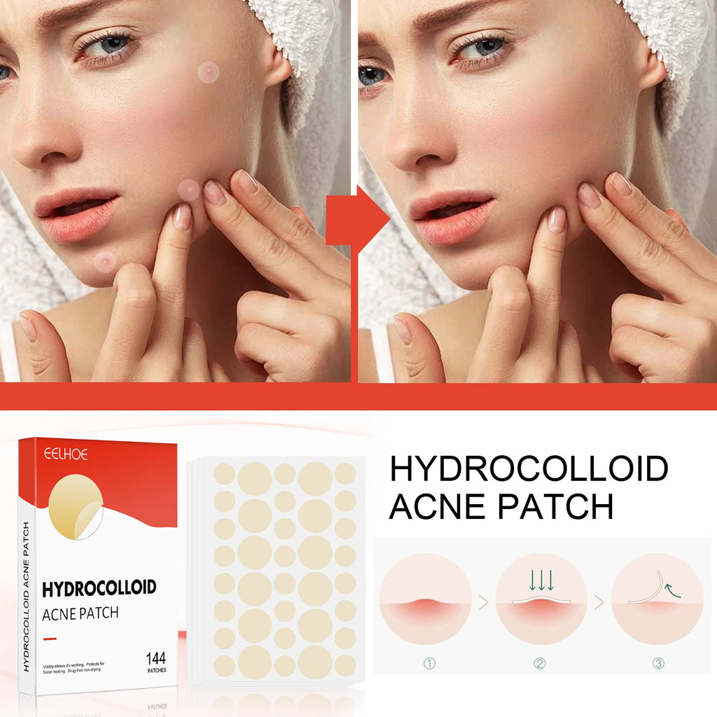 Hydrocolloid Acne Patches - 144 Count Invisible Blemish Patch, Ultra-Thin Skin Care Stickers for Gentle Blemish Care