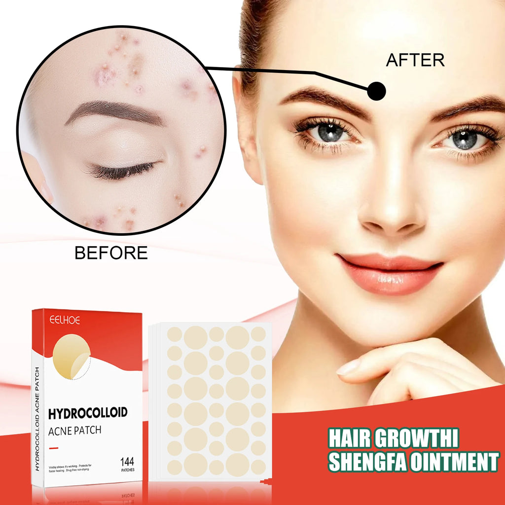 Hydrocolloid Acne Patches - 144 Count Invisible Blemish Patch, Ultra-Thin Skin Care Stickers for Gentle Blemish Care