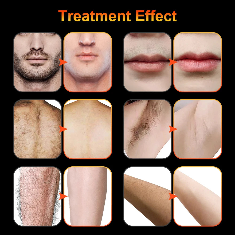 Professional Permanent Electrolysis Hair Removal Machine Painless Needle Epilation