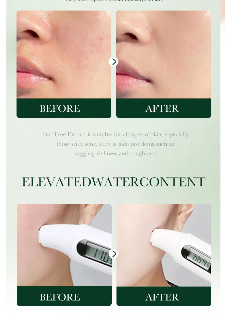 Tea Tree Acne Removing Cream Facial skincare Oil Control Face Gel Creams Hydrating Moisturizing Facial Cream Skin Care Set
