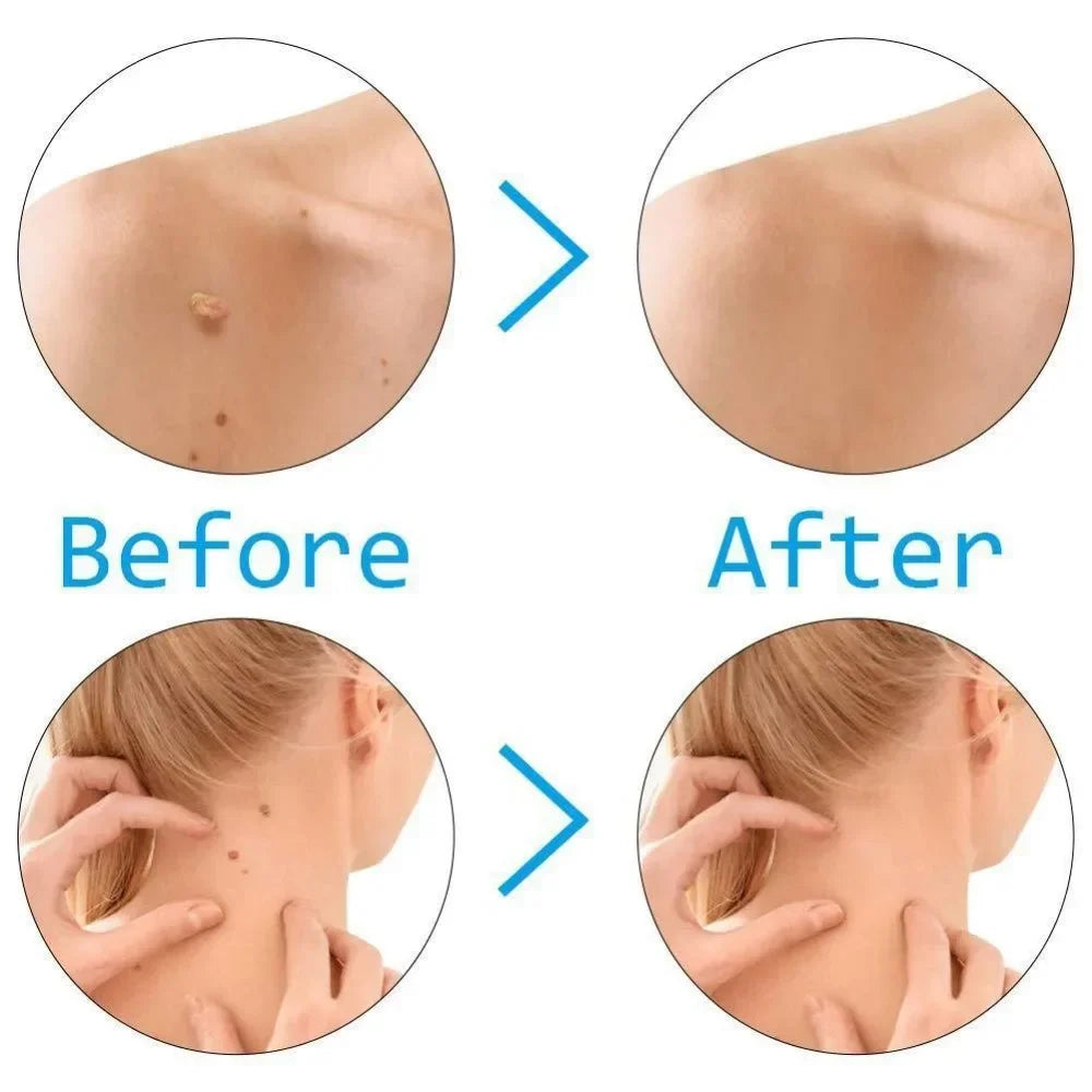 2-in-1 Skin Tag Removal Kit Skin Mole Wart Remover Device Dots Acne Flesh Face Pot Treatment Beauty Tools Skin Care Tools