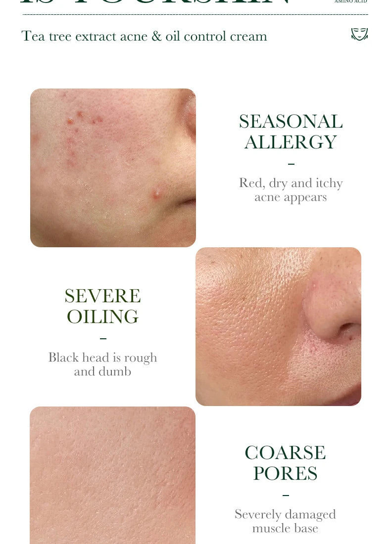 Tea Tree Acne Removing Cream Facial skincare Oil Control Face Gel Creams Hydrating Moisturizing Facial Cream Skin Care Set