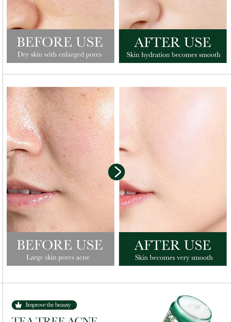 Tea Tree Acne Removing Cream Facial skincare Oil Control Face Gel Creams Hydrating Moisturizing Facial Cream Skin Care Set