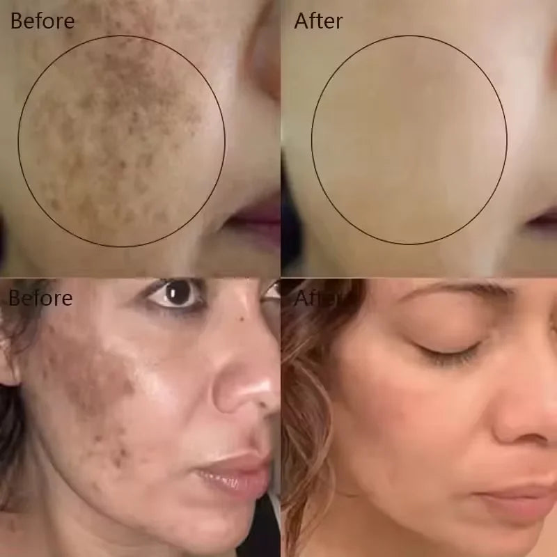 Whitening Freckle Serum Melanin Correcting Fade Pigment Remove Melasma Moisturizing Dark Spot Brighten Beauty Skin Care Essence