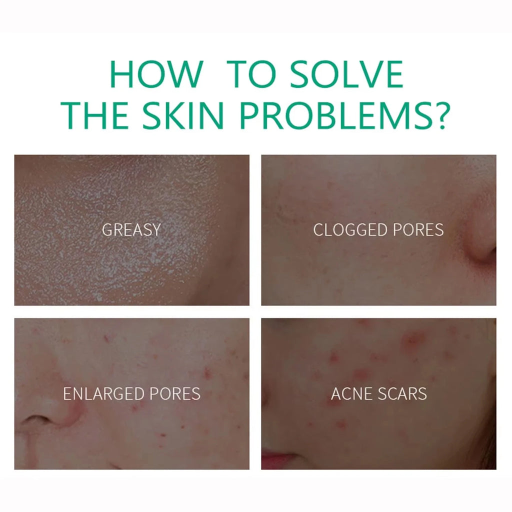 Smoothing Pimple Gel Blackhead Remove Repair Face Cream Oil Control Shrink Pores Moisturizing Brighten Skin Care Korean Cosmetic