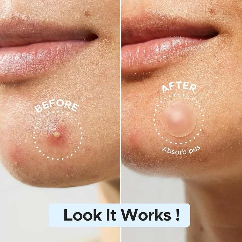 Acne Pimple Patch Invisible Waterproof Absorb Pus Acne Pimple Remover Tool Acne Cleaner Korean Skin Care Product