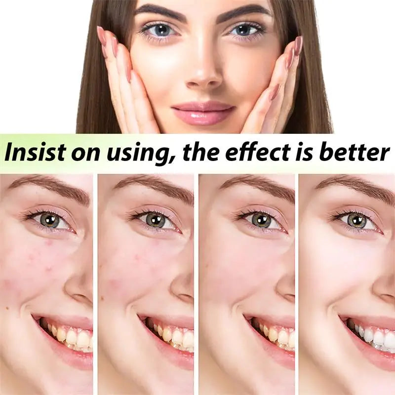 Natural Herbs Acid Acne Cream Shrink Pores Blackheads Scars Acne Marks Blemishes Oil Control Whitening Korean Skin Care Products