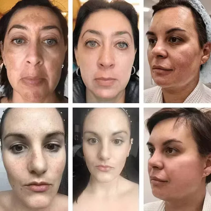 Whitening Freckle Serum Melanin Correcting Fade Pigment Remove Melasma Moisturizing Dark Spot Brighten Beauty Skin Care Essence