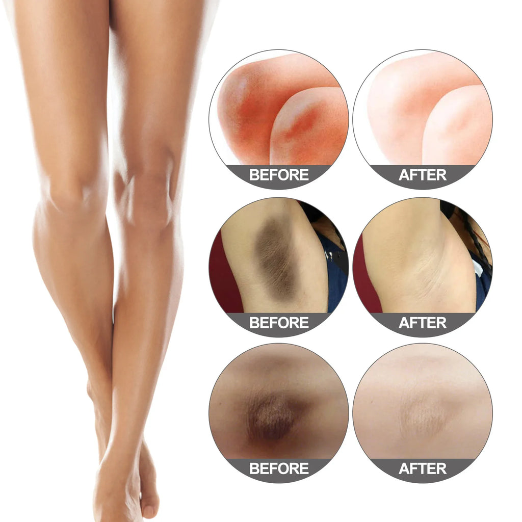 Body Bleaching Set Private Parts Lightening Snow Bleach Intimate Areas Whitening Pigmentation Melanin Brighten Skin Care Product