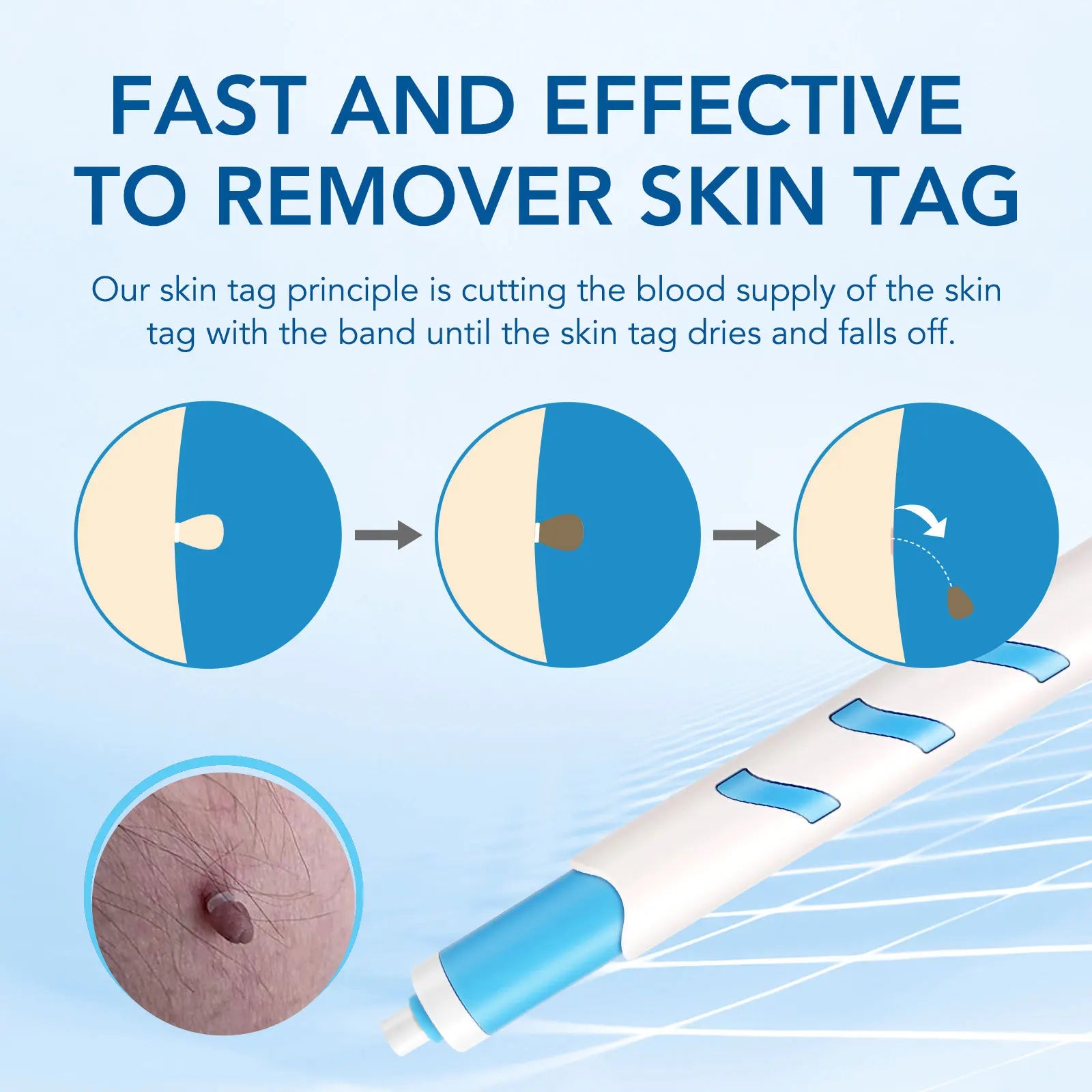 Small Single Head Auto Skin Tag Removal Kit For Small Skin Tags 1-4mm With Cleansing Swabs Home Use Beauty Face Skin Care Tool