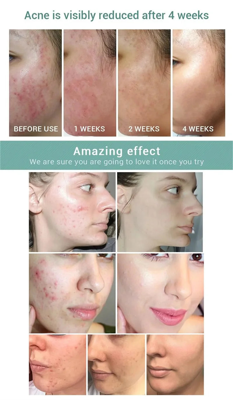 Salicylic Acid Acne Treatment Face Cream Repair Pimple Spots Deep Cleaning Pore Anti-acne Scar Oil Control Moisturizer Skin Care