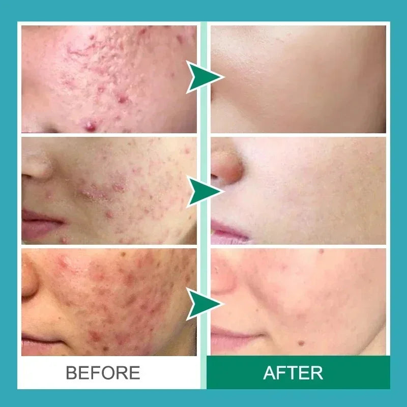 Effective Acne Removal Cream Anti-Acne Repair Redness Pimple Spots Gel Deep Cleaning Pore Oil Control Moisturizing Skin Care 30g